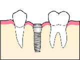 インプラント治療の流れ