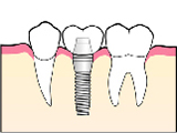 インプラント治療の流れ